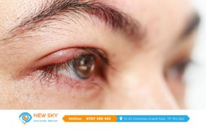 Bệnh viêm kết mạc là gì và cách phòng ngừa ai cũng cần biết